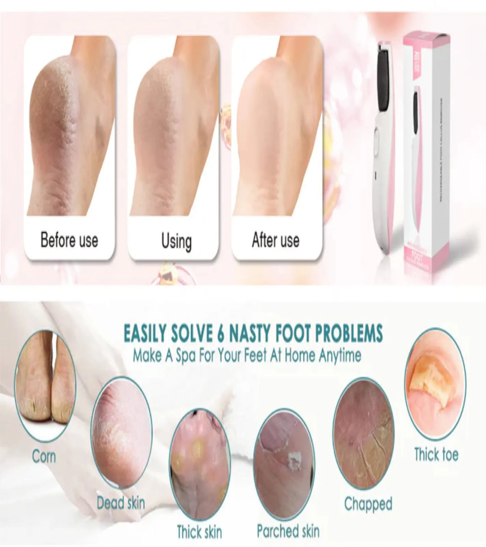 Before and after results of electric foot callus remover for dead skin and cracked heels